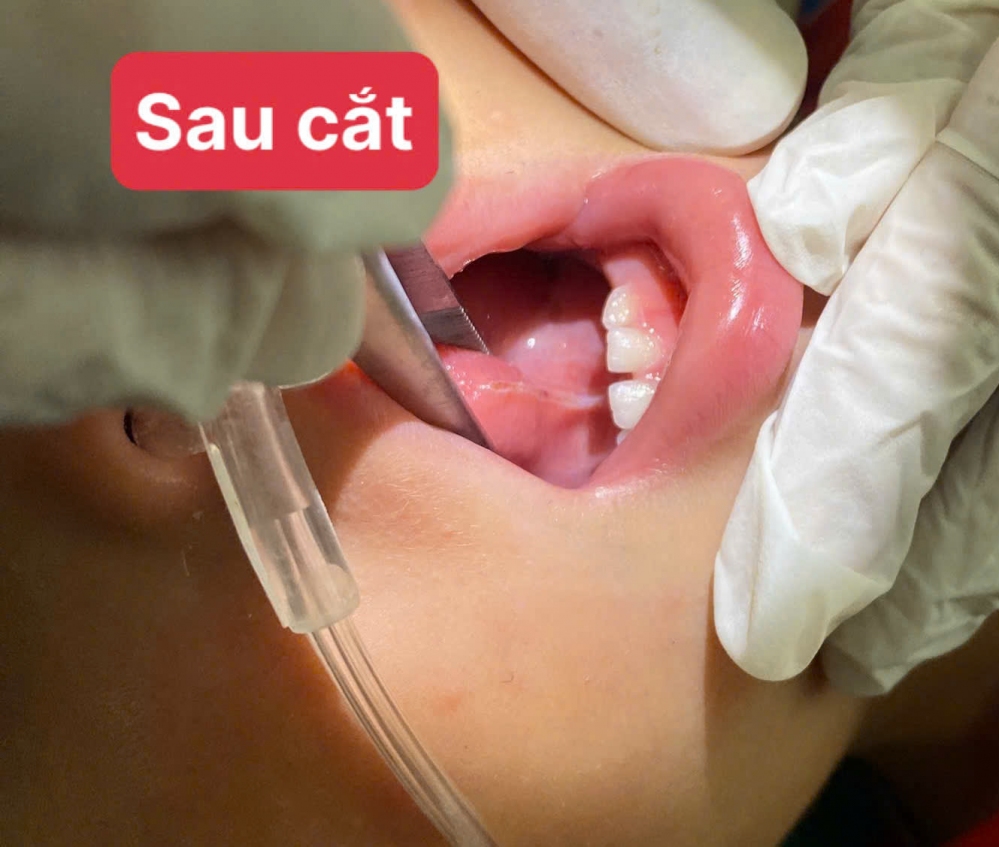 BỆNH VIỆN ĐA KHOA KHU VỰC ĐỒNG VĂN THỰC HIỆN CẮT THẮNG LƯỠI BẰNG DAO DIỆN CAO TẦN