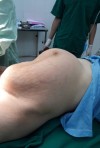 Hình ảnh bụng bệnh nhân trước phẫu thuật