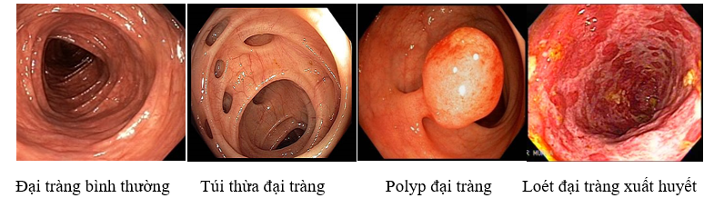 hình ảnh Nội soi Đại Tràng